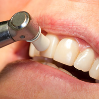 Verwijderen van aanslag door de tanden te polijsten