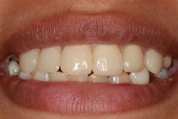 Situatie na. De tanden zijn netjes opgebouwd met composiet en zien er nu veel fraaier en frisser uit.